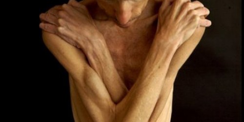 L’anoressia colpisce sempre più uomini